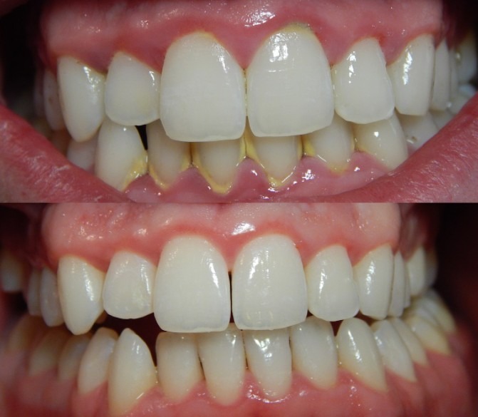 Kills Harmful Bacteria in Your Mouth