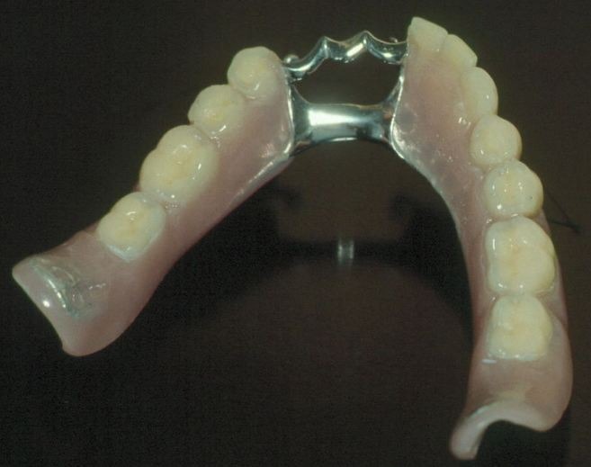 Dental Bridging