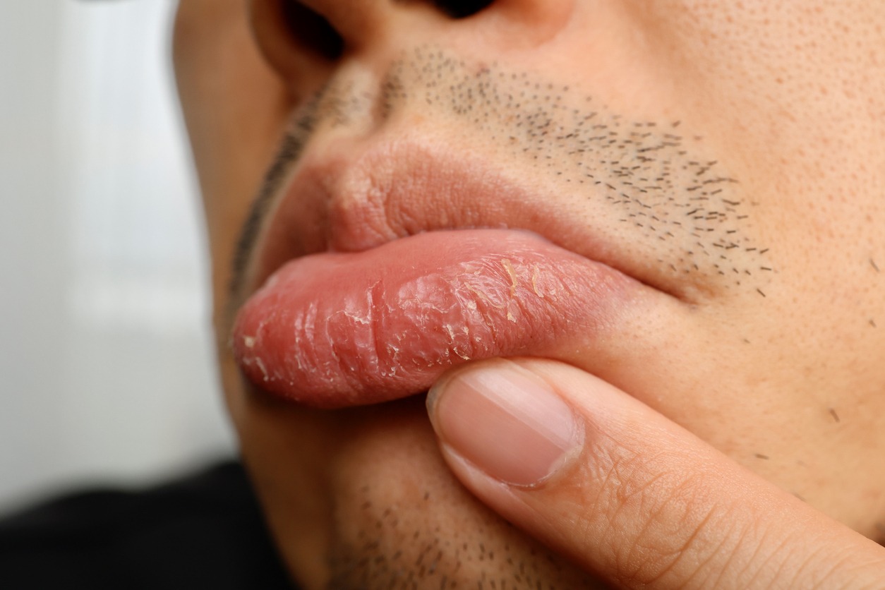 The male lower lip is damaged and rough due to dryness.