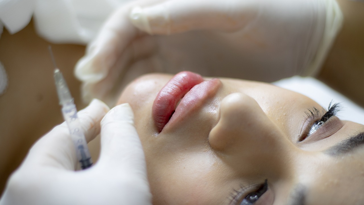 Understanding Lip Fillers