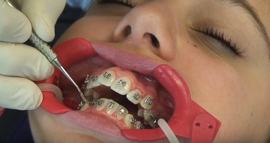 installing-teeth-braces
