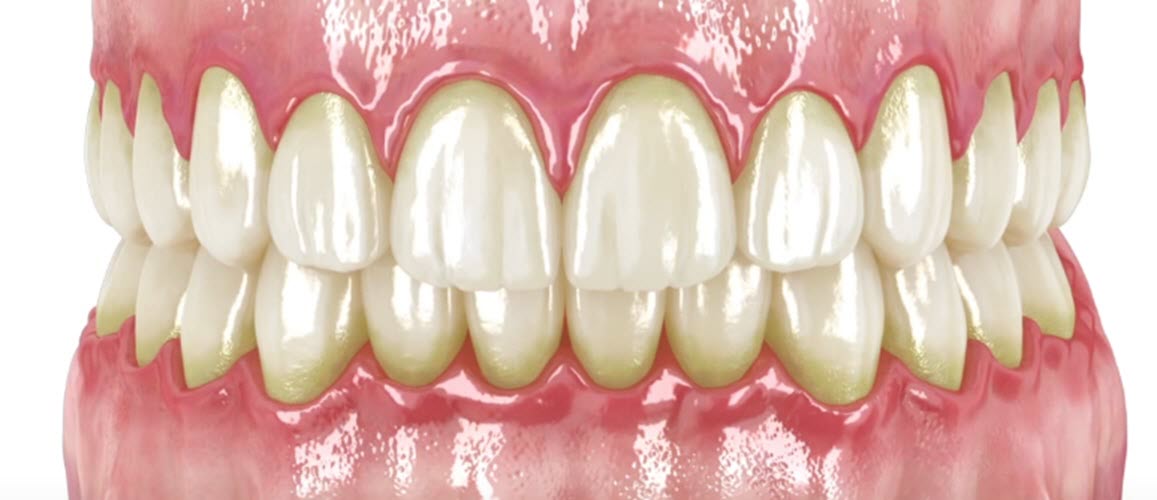 Periodontitis tooth