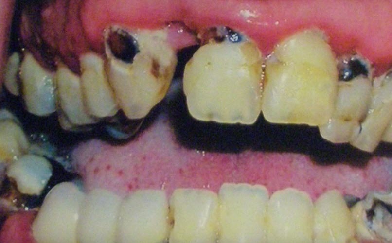 Sensitivity teeth does not mean