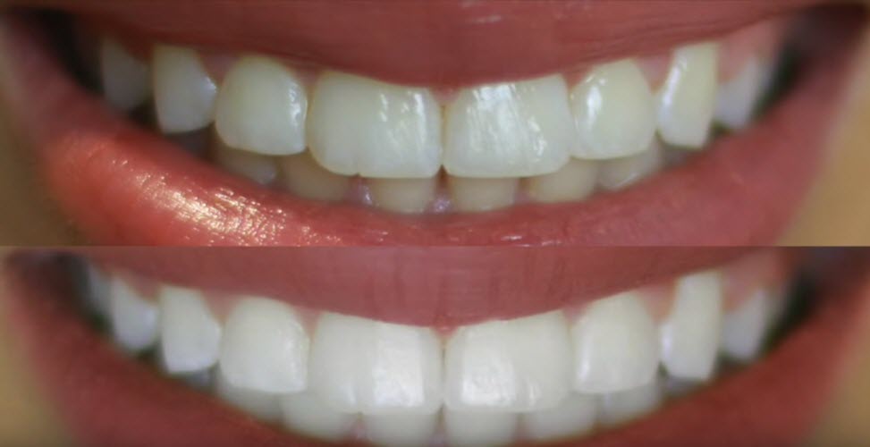 teeth whitening comparison
