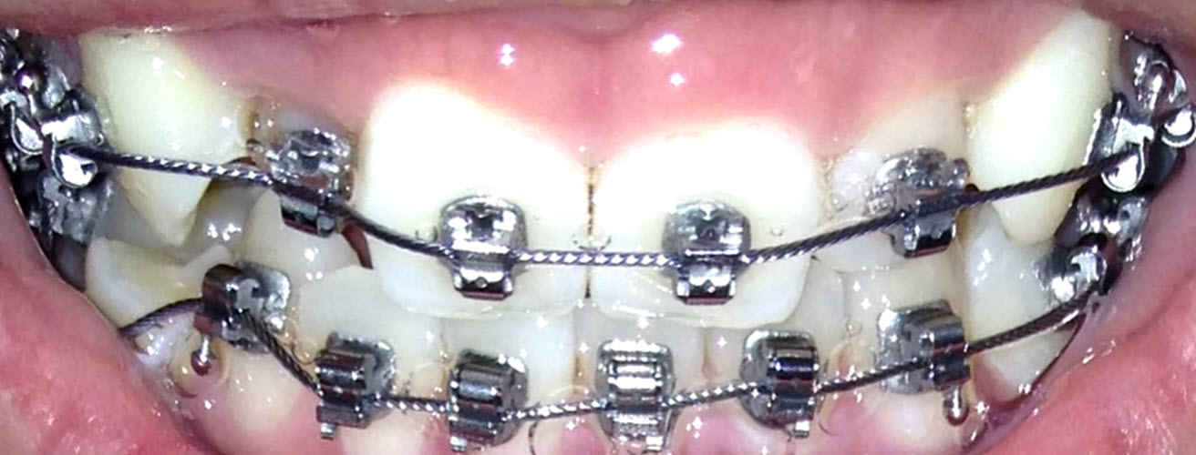 Unique tooth braces