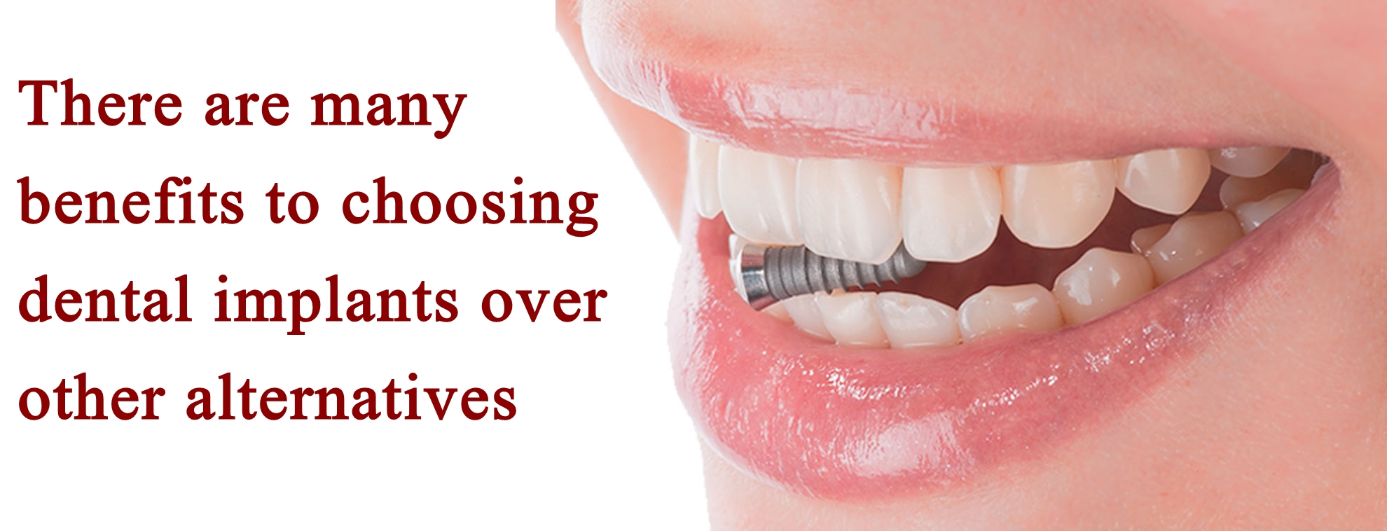 Benefits dental implants