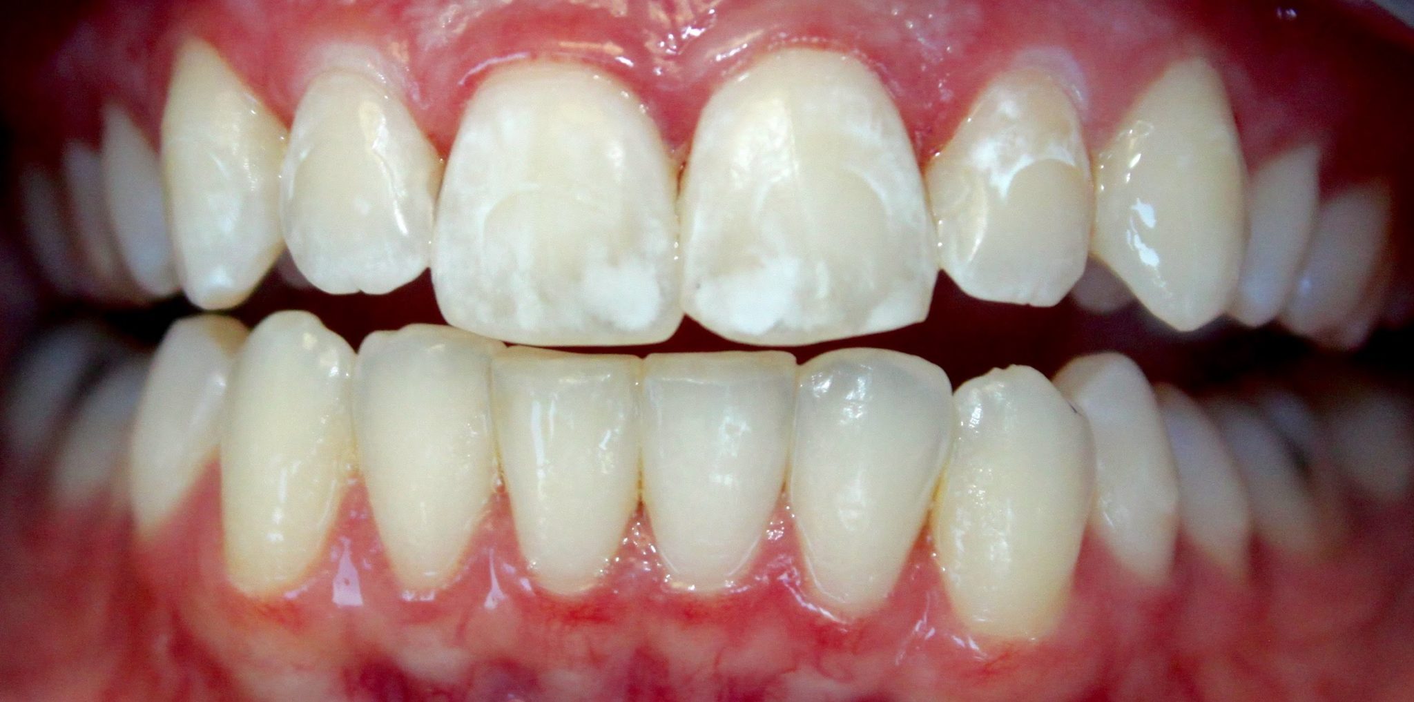 You have white spots on your teeth
