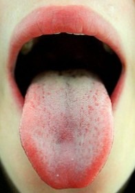 What Is Halitosis?