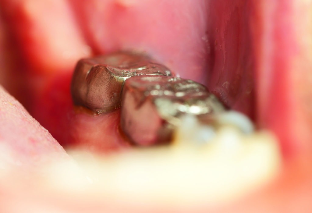 Restoration of teeth after endodontic treatment