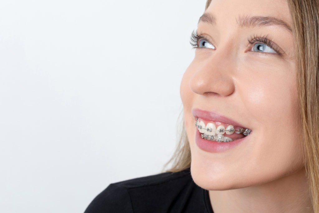 Young woman with brackets on teeth