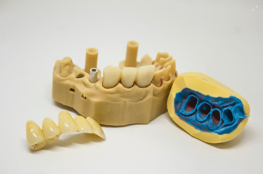 Denture Implant Fit and Placement 