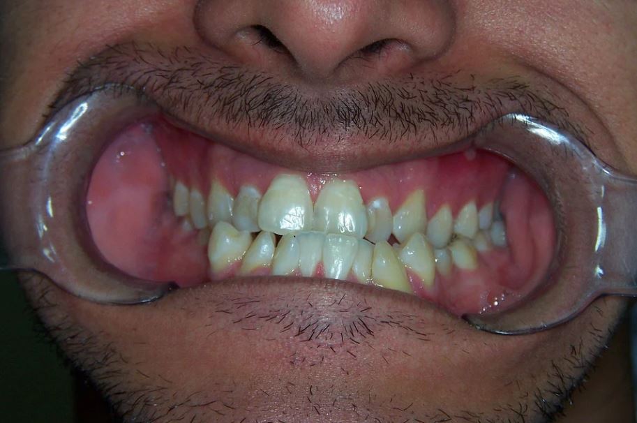 Invisalign change the placement of teeth gradually.