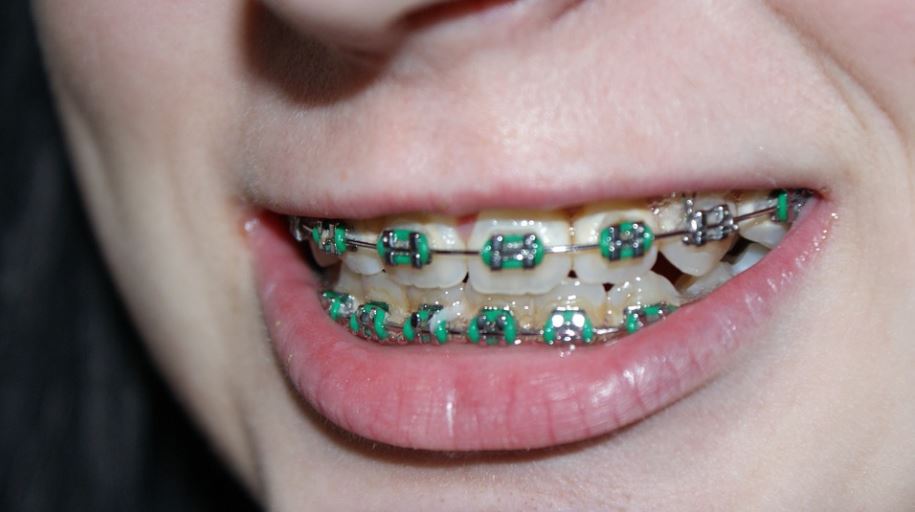 Teens and adults show best results from braces