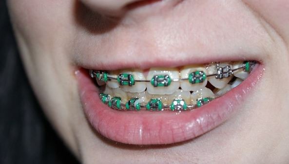 Teeth braces
