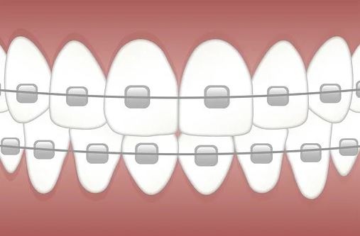 a Teeth braces