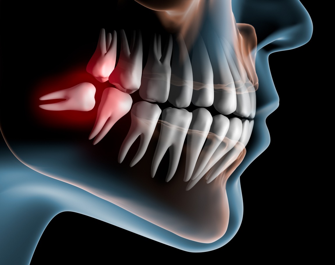 benefits-of-keeping-wisdom-teeth--dentist