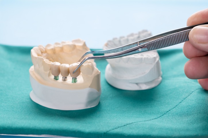 permanent-restorations-dental-bridges-vs-crowns