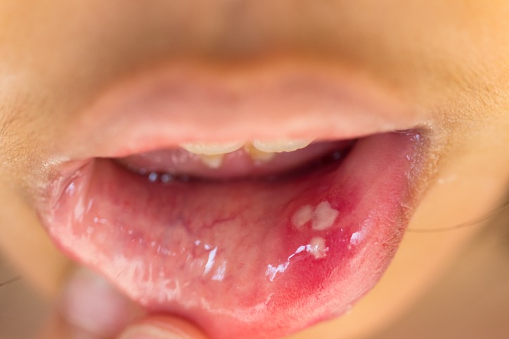 What Causes Canker Sores in the Mouth?