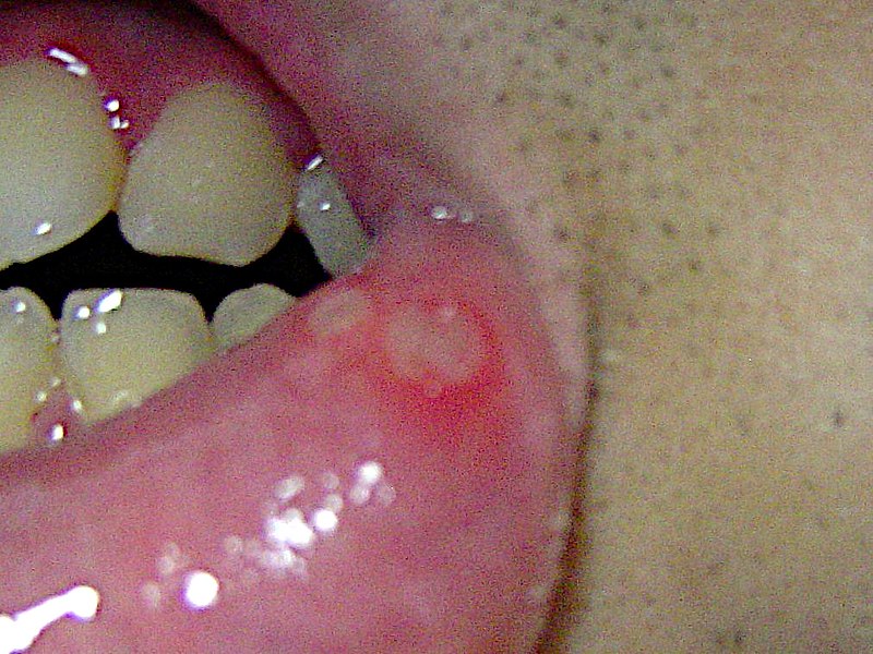 the lower lip is retracted, revealing aphthous ulcers on the labia mucosa