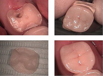 All-ceramic-Dental-Onlay-for-a-molar-tooth