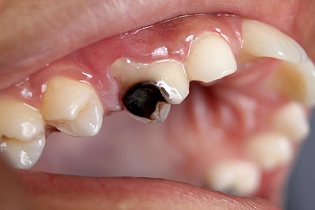 Destruction-of-a-tooth-by-dental-caries-and-disease
