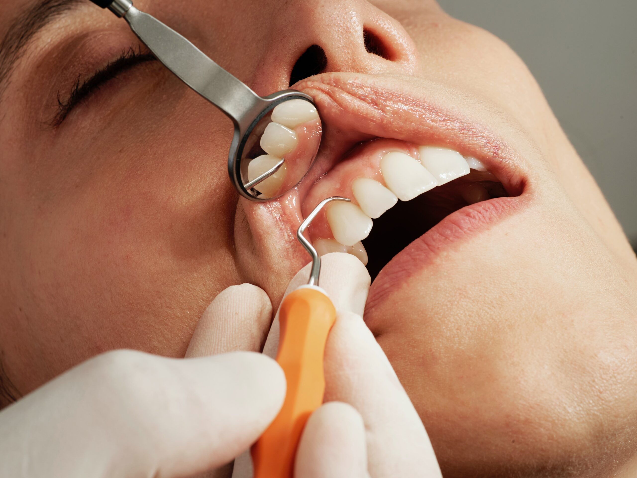 Wellness-Dentist-Scaling-Prophylaxis-Dental-Treatment-Probing-Dental-Human-Face-Teeth-Mouth-Lip