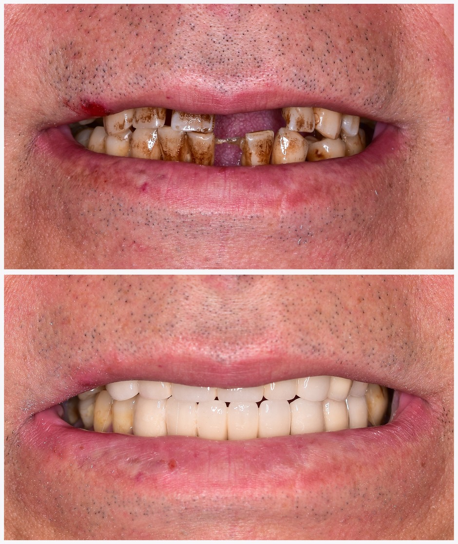 before after restored teeth dental implants