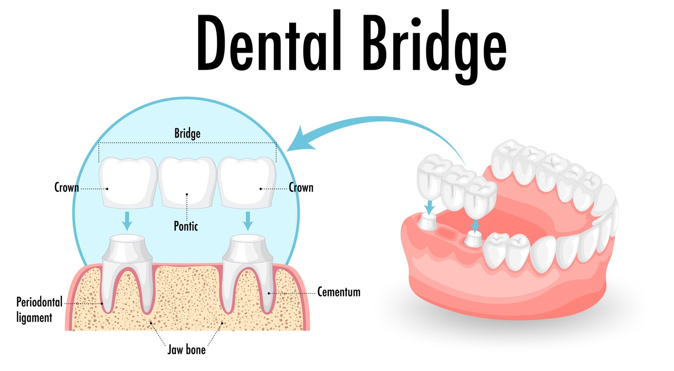 dental bridges diagram