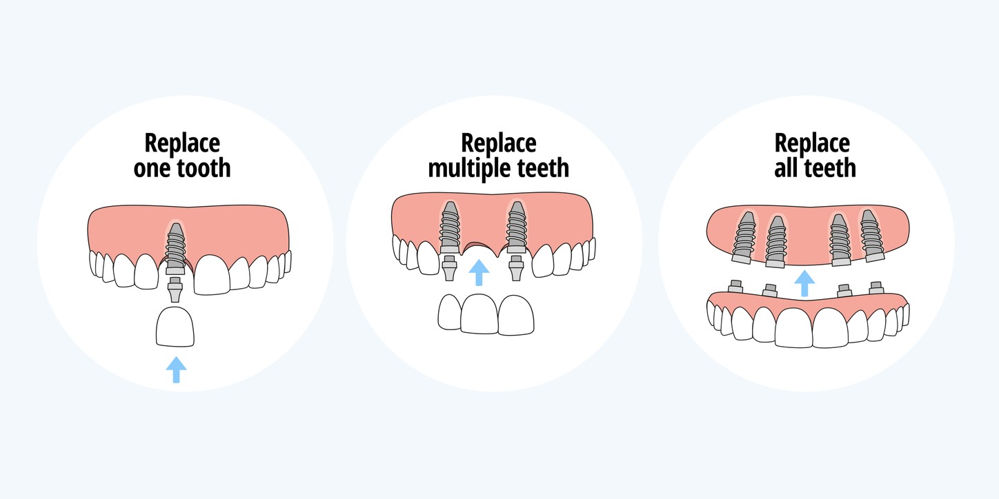 dental implants replace teeth