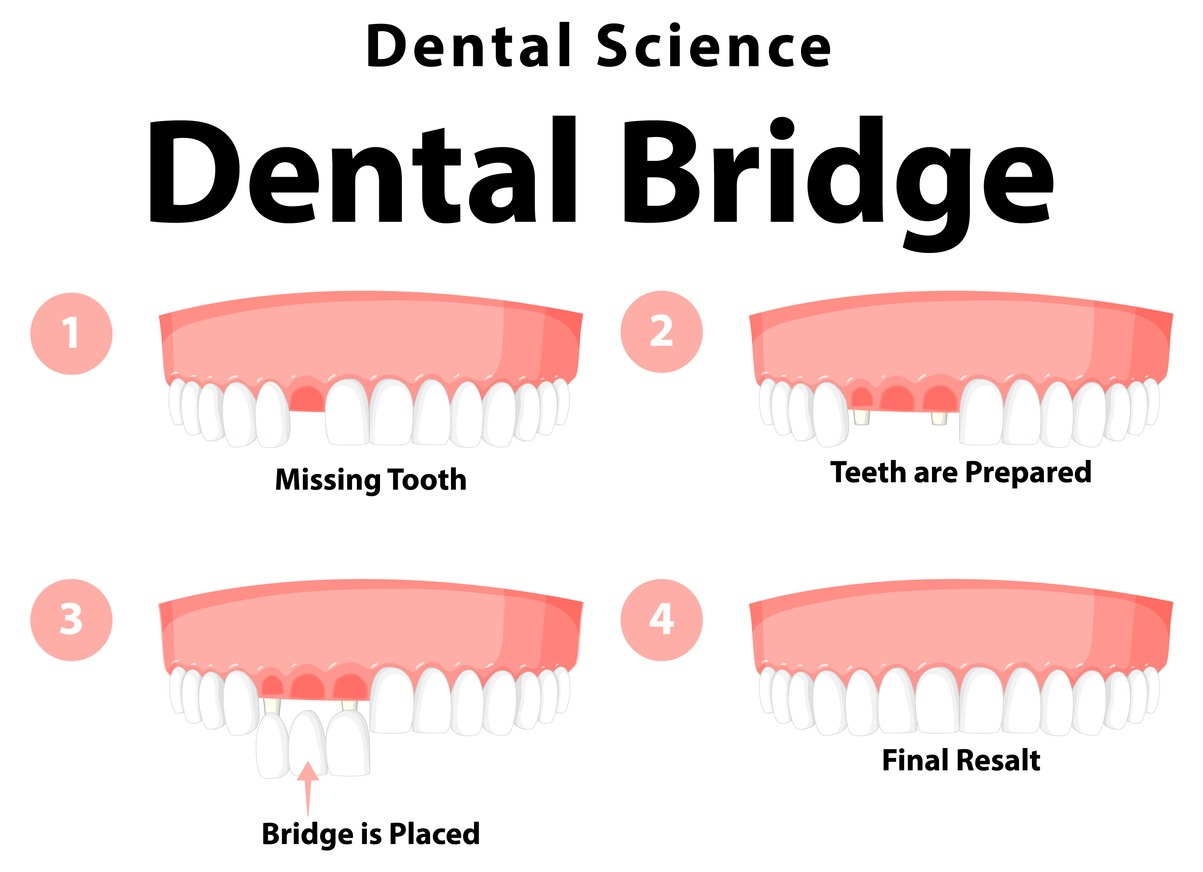 dental science dental bridges