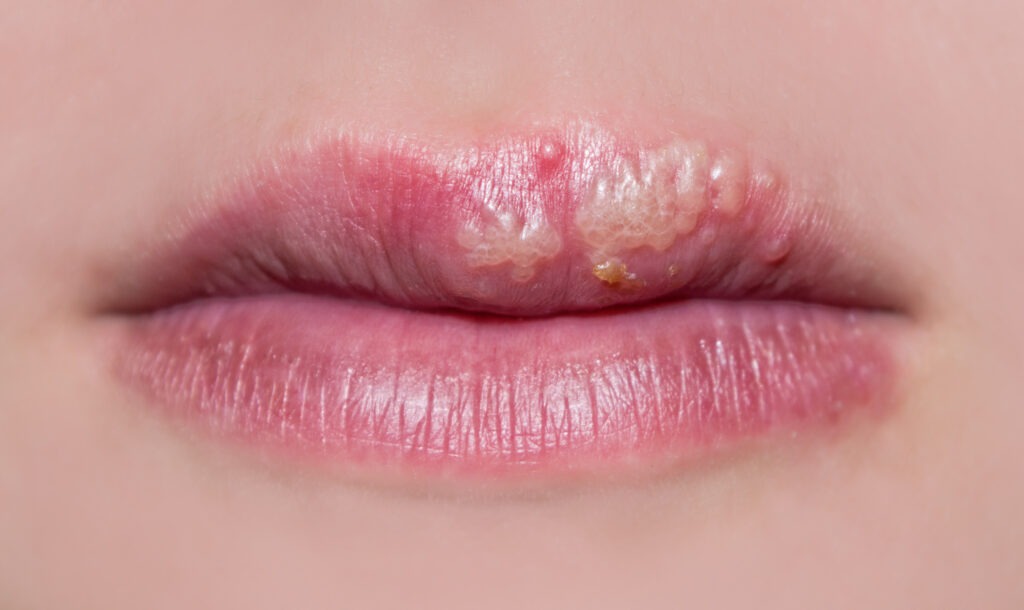 manifestations of herpes on the lips of a girl