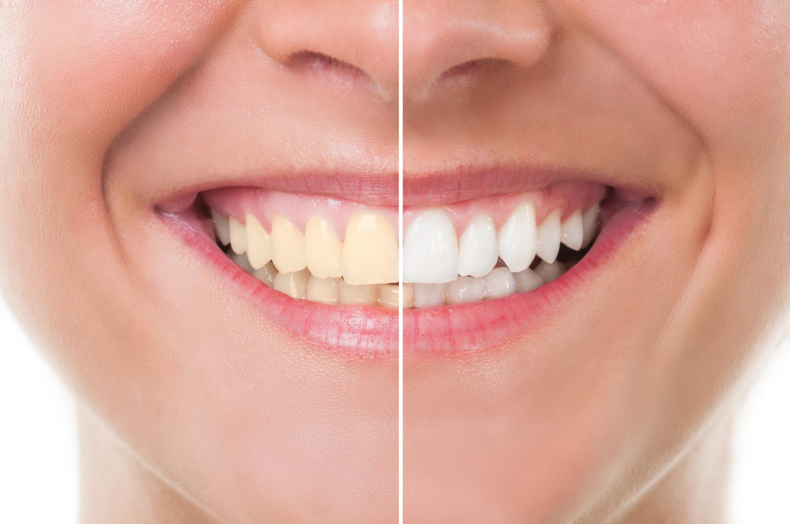 Perfect woman smile before and after whitening.