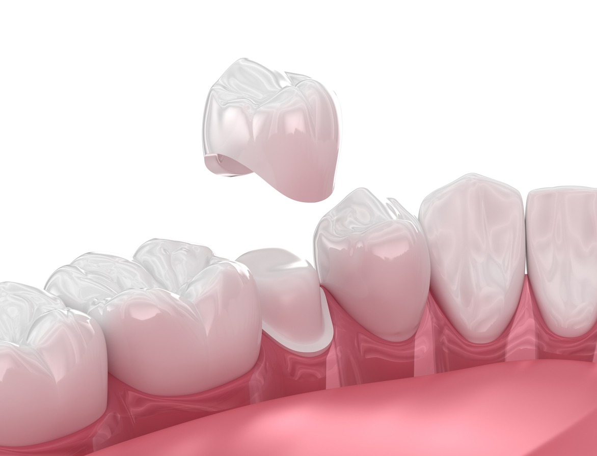 Dental crown placement over tooth