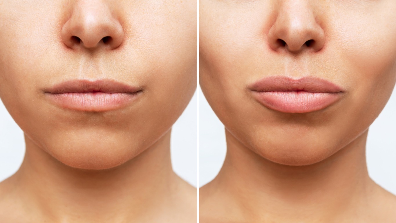 Types of Lip Fillers Explained