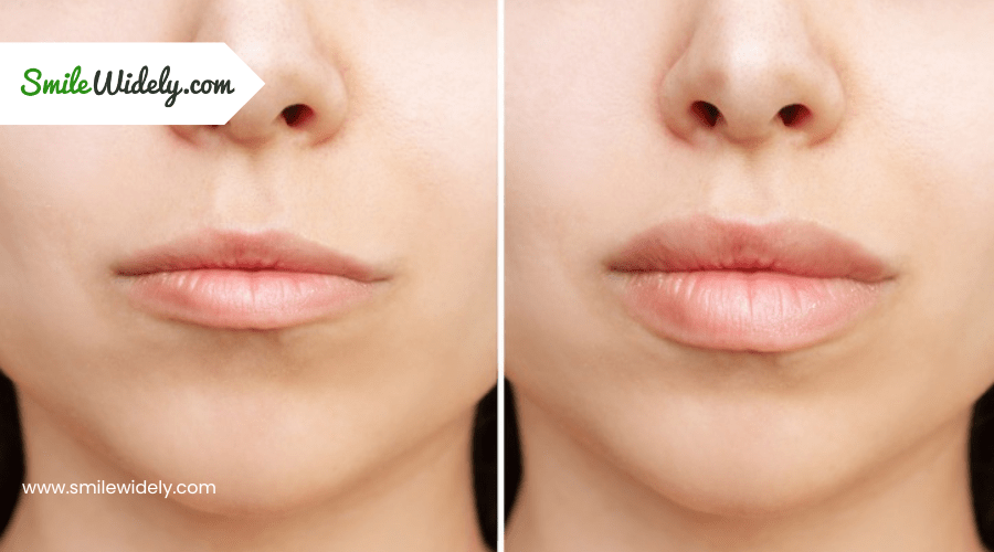 How Are Lips and Facial Attractiveness Symmetry Connected